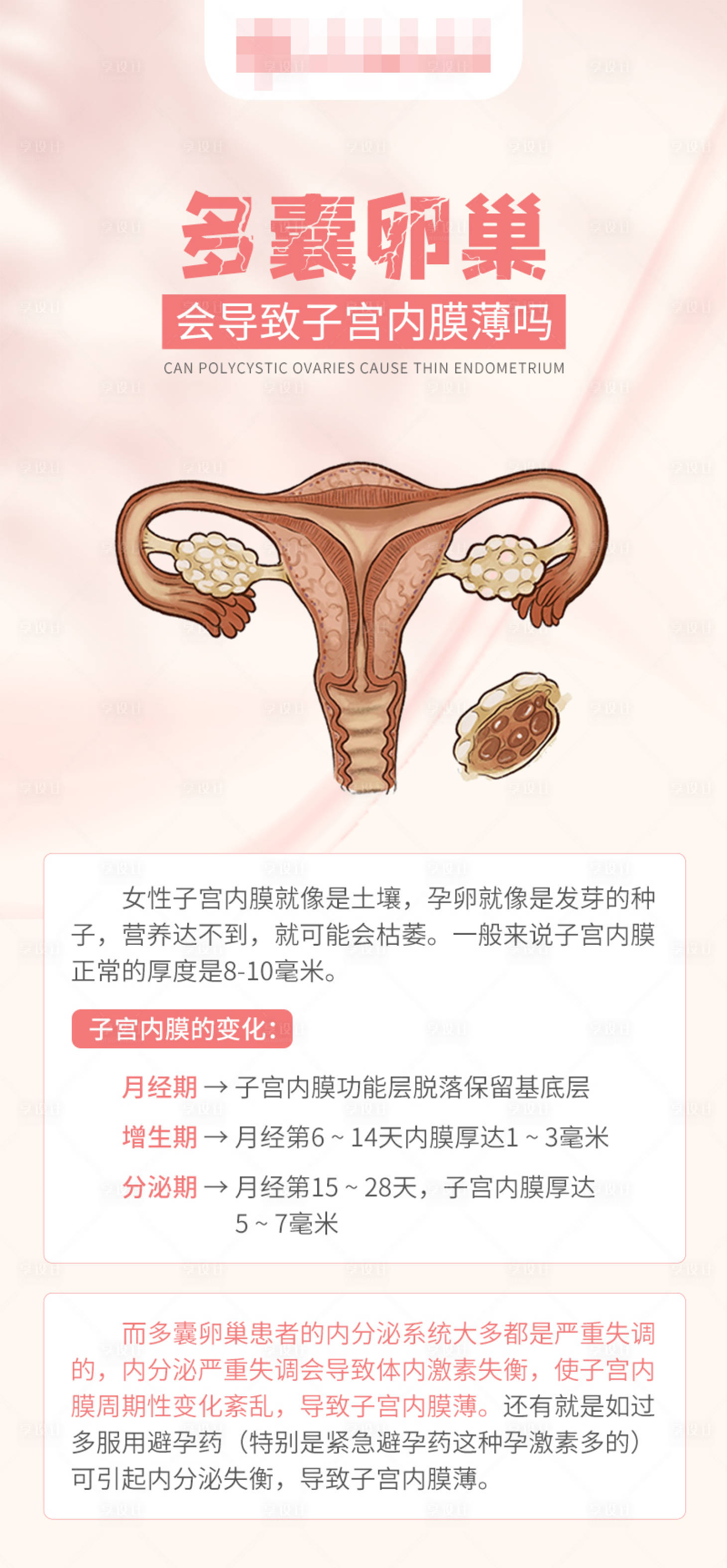 源文件下载【多囊卵巢会导致子宫内膜薄海报】编号：72180017328533272