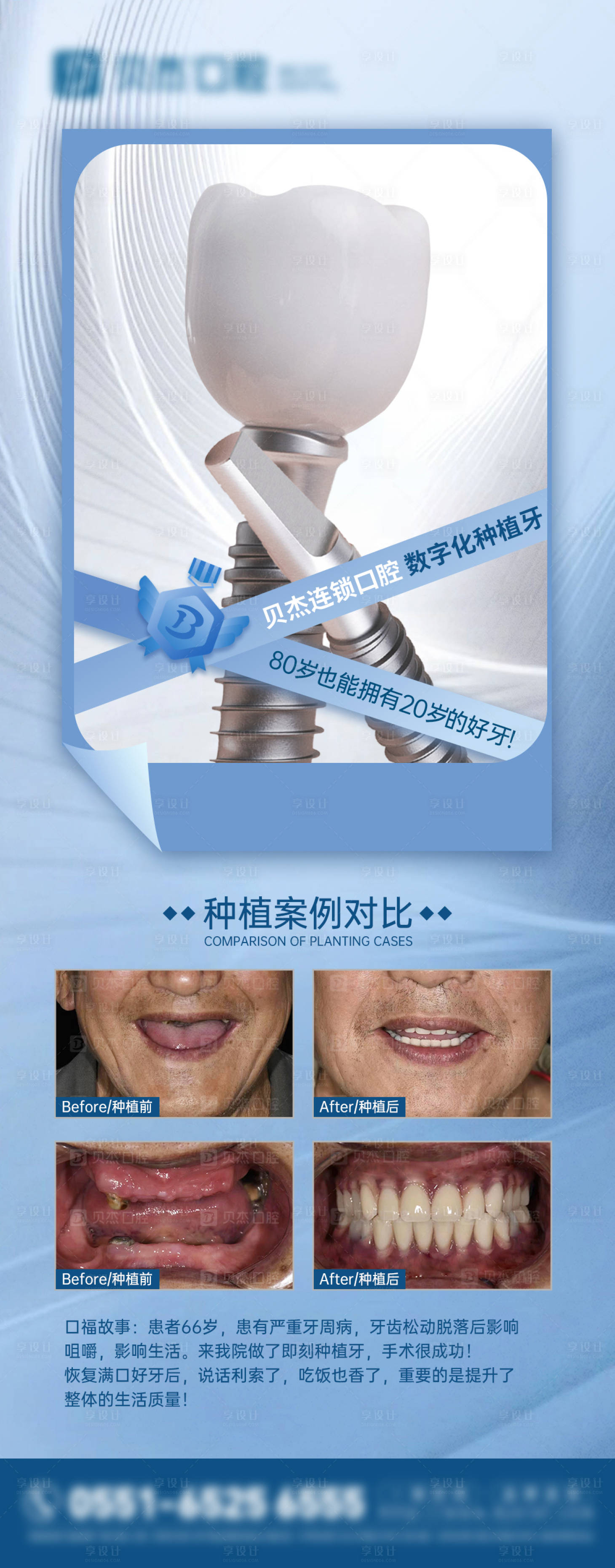 源文件下载【享设计】搜索编号：92060017666081377【种植牙海报】