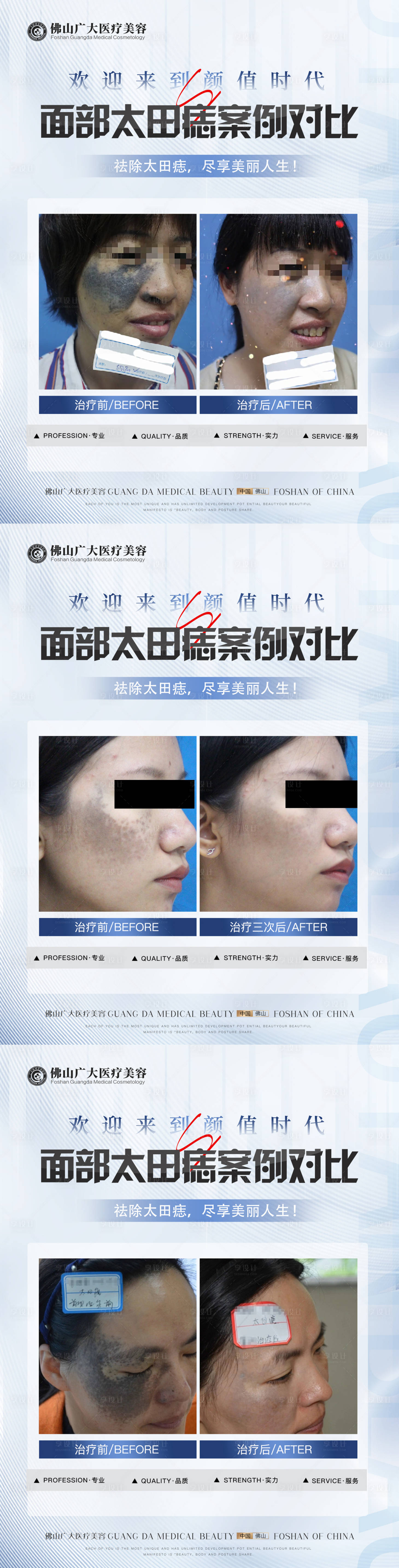 源文件下载【享设计】搜索编号：36510017099356350【医美太田痣案例】