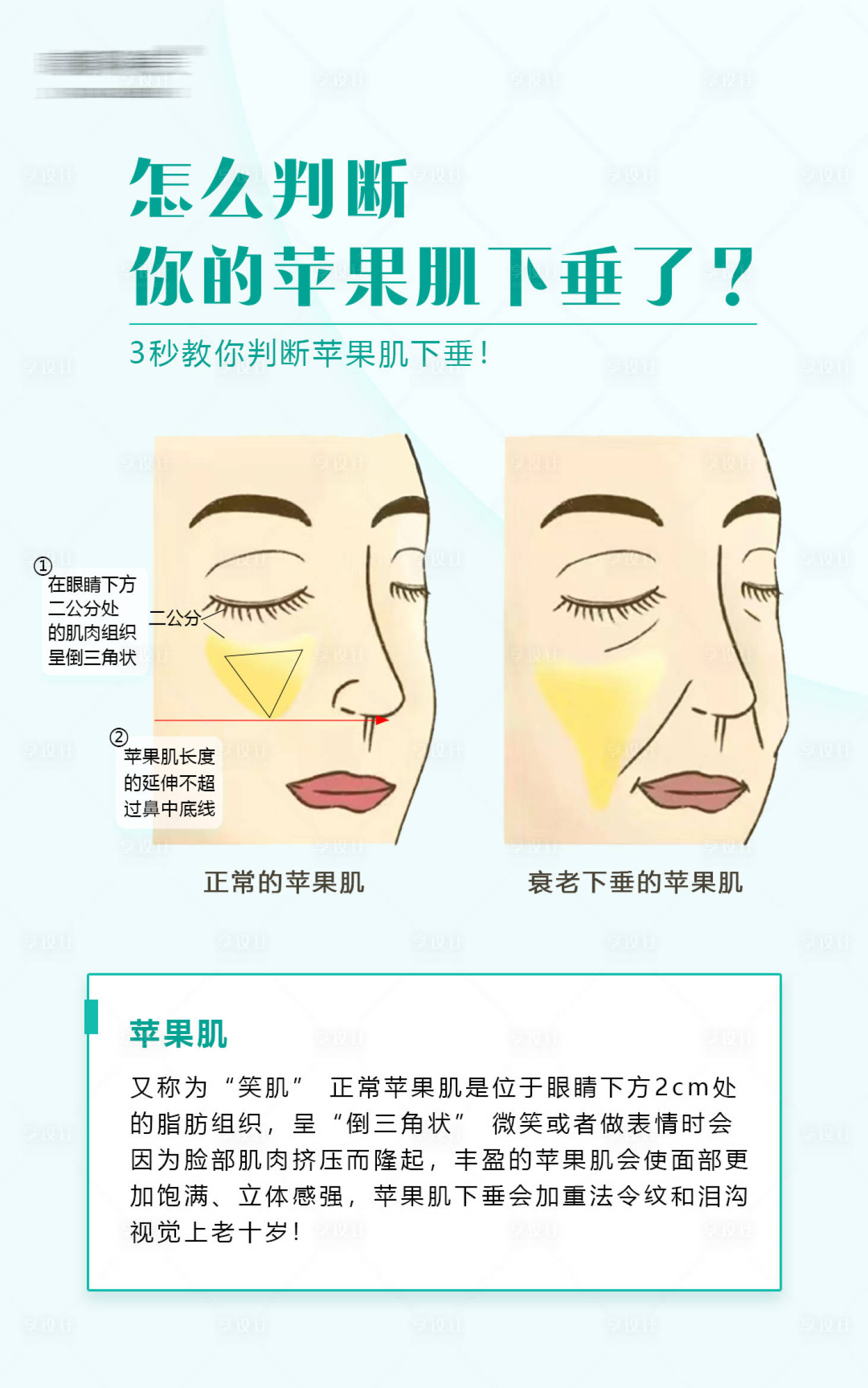 源文件下载【享设计】搜索编号：85070017575131359【苹果肌下垂科普海报】
