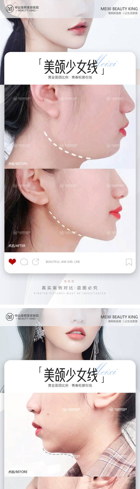 源文件下载【下颌线案例海报】编号：83600017656115544
