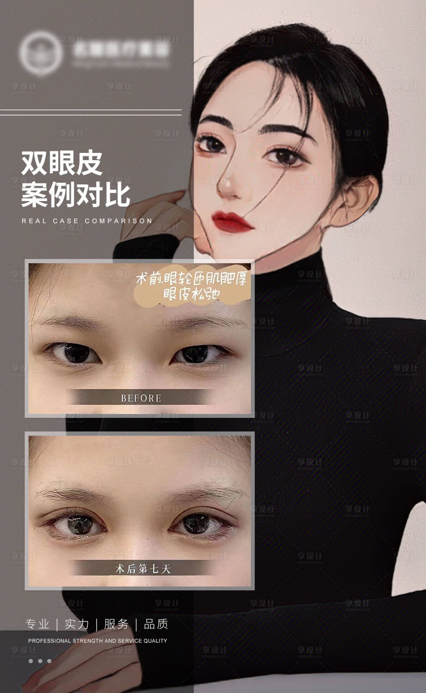 源文件下载【双眼皮案例对比】编号：81880017329069914