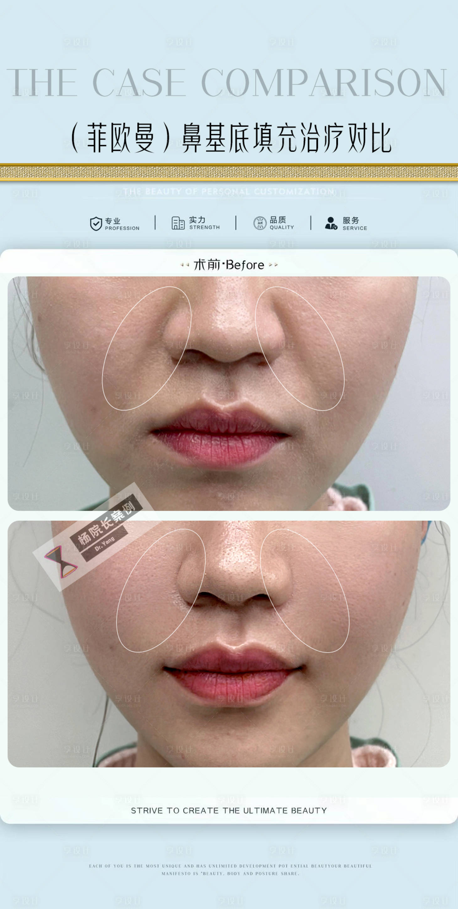 源文件下载【享设计】搜索编号：87220017331272447【医美案例对比鼻基底填充法令纹对比】