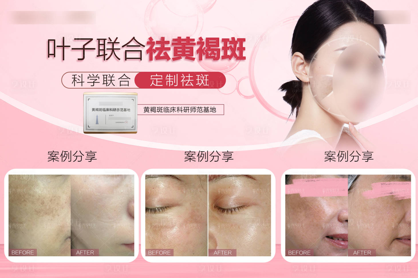 源文件下載【享設(shè)計(jì)】搜索編號：64270018394458951【醫(yī)美祛斑活動(dòng)背景板】