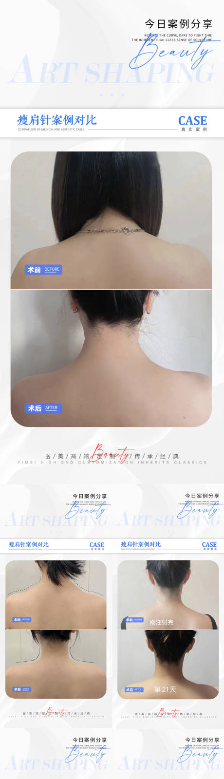 源文件下载【医美瘦肩针案例对比海报】编号：26100018028672676