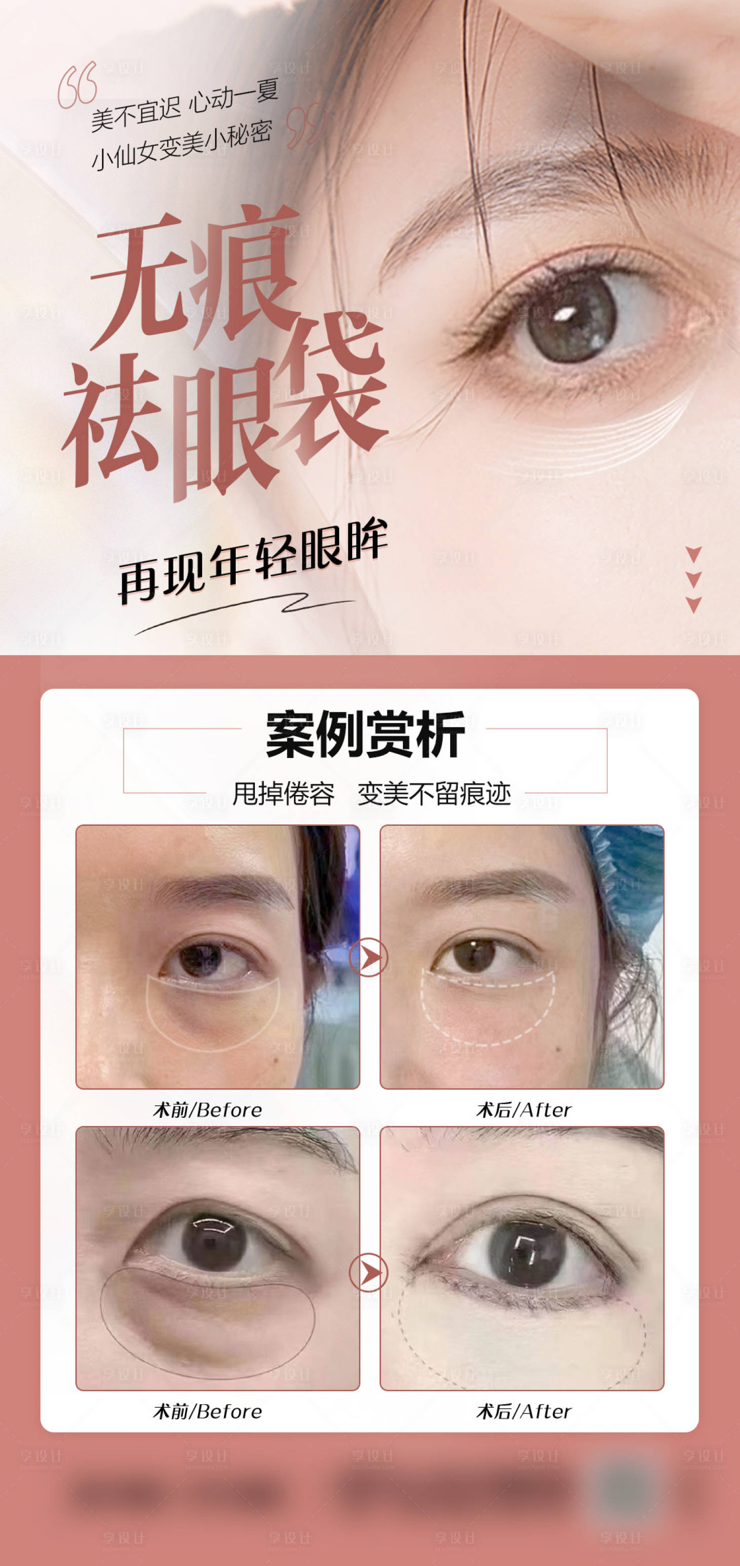 源文件下载【享设计】搜索编号：21240018292059079【祛眼袋医美海报】