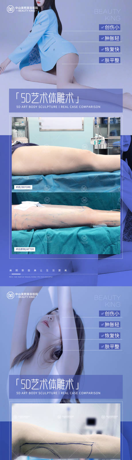 源文件下载【医美体雕吸脂案例海报】编号：20230701172935831