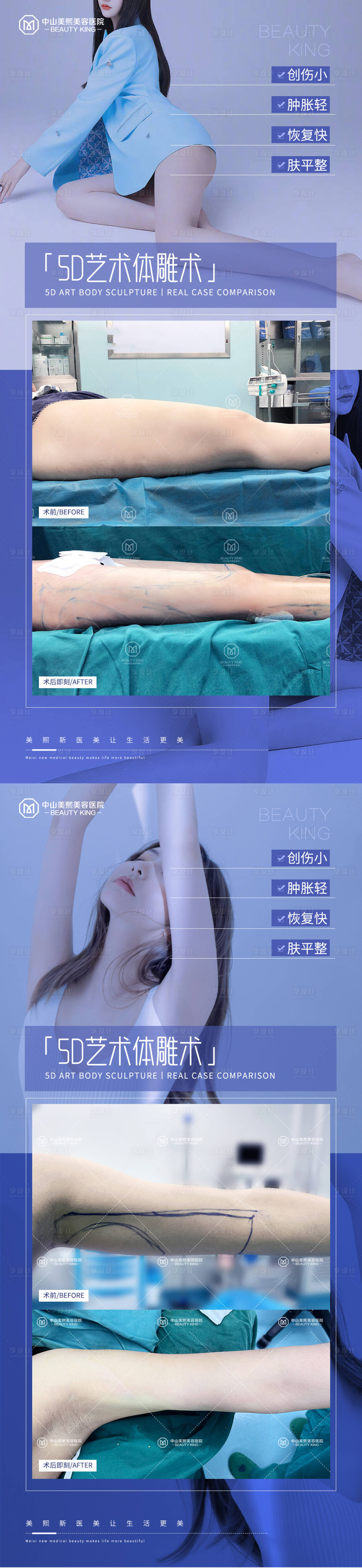 源文件下载【享设计】搜索编号：56850017749823676【医美体雕吸脂案例海报】