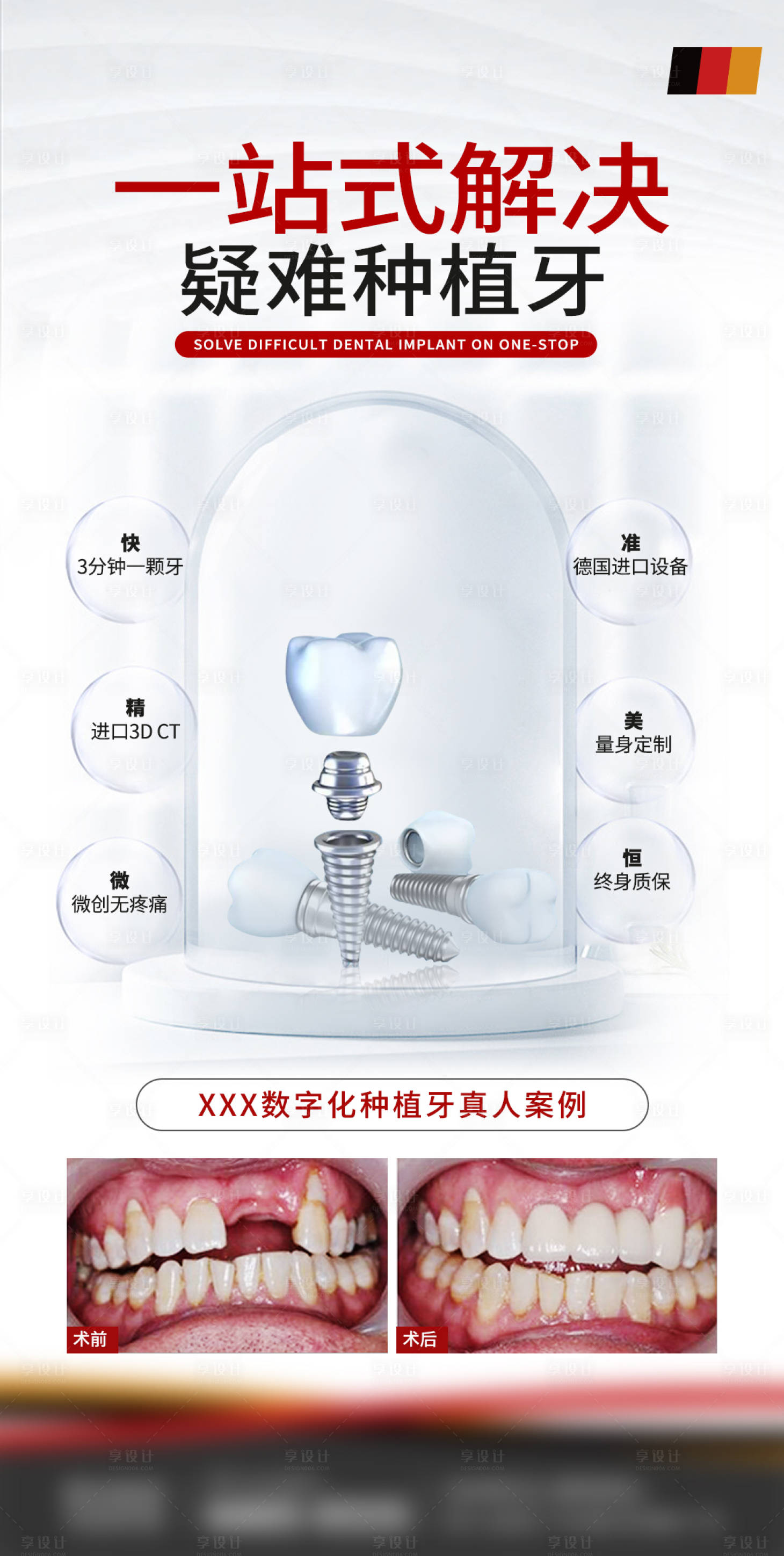 源文件下载【享设计】搜索编号：89200018077056654【口腔种植牙优势科普】