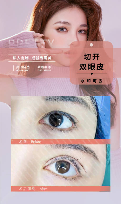 源文件下载【双眼皮案例眼部整形】编号：71630018383796808