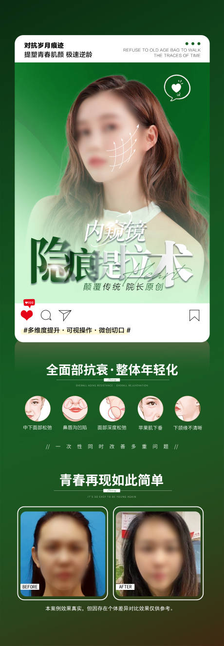 源文件下载【享设计】搜索编号：16600018288339174【内窥镜隐痕提拉术】