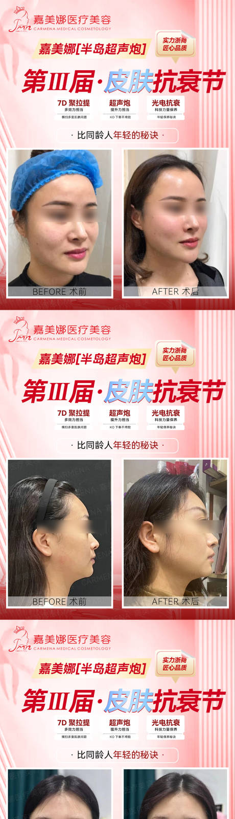 源文件下載【享設計】搜索編號：52530018120273547【超聲炮抗衰案例對比海報展板】