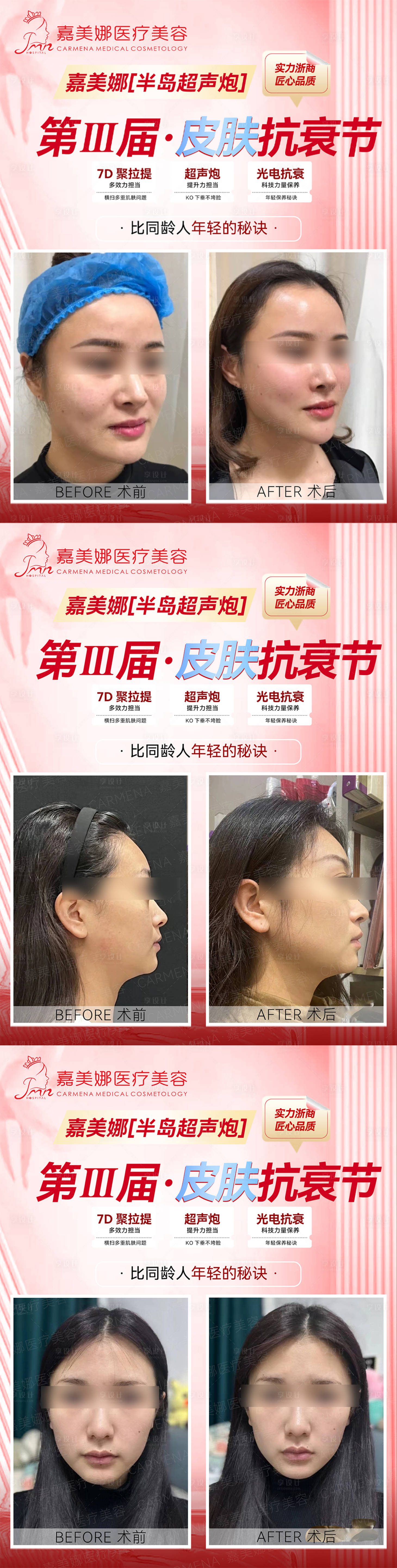 源文件下載【享設(shè)計】搜索編號：52530018120273547【超聲炮抗衰案例對比海報展板】