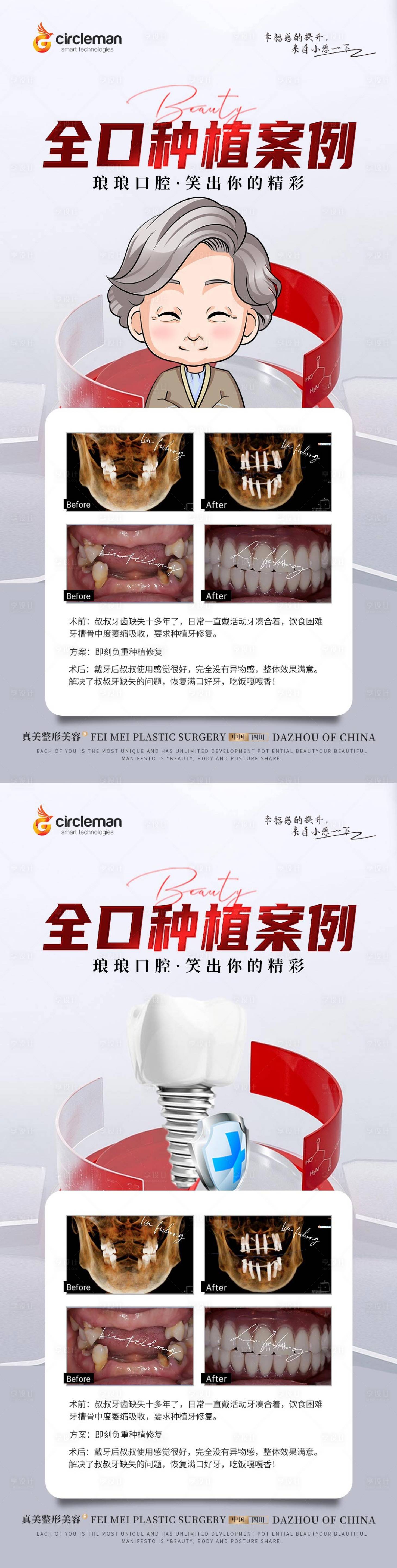 源文件下载【口腔案例种植牙海报】编号：22910018092427283