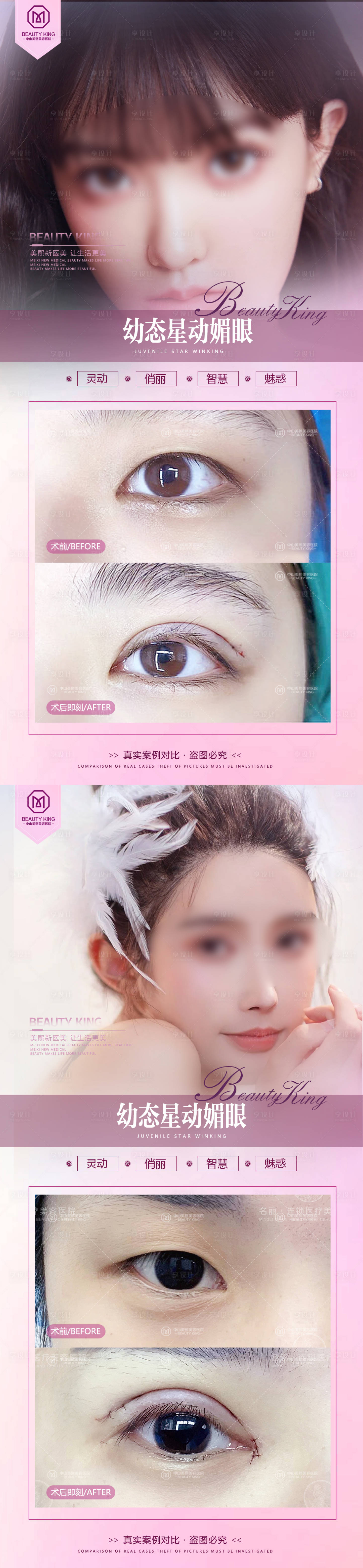 源文件下载【享设计】搜索编号：15020017750227295【医美双眼皮案例宣传海报】