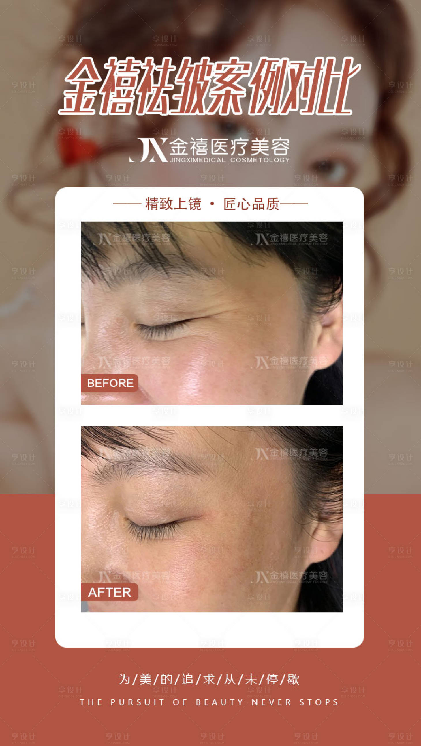 源文件下载【享设计】搜索编号：83240017917255210【医美案例对比海报】