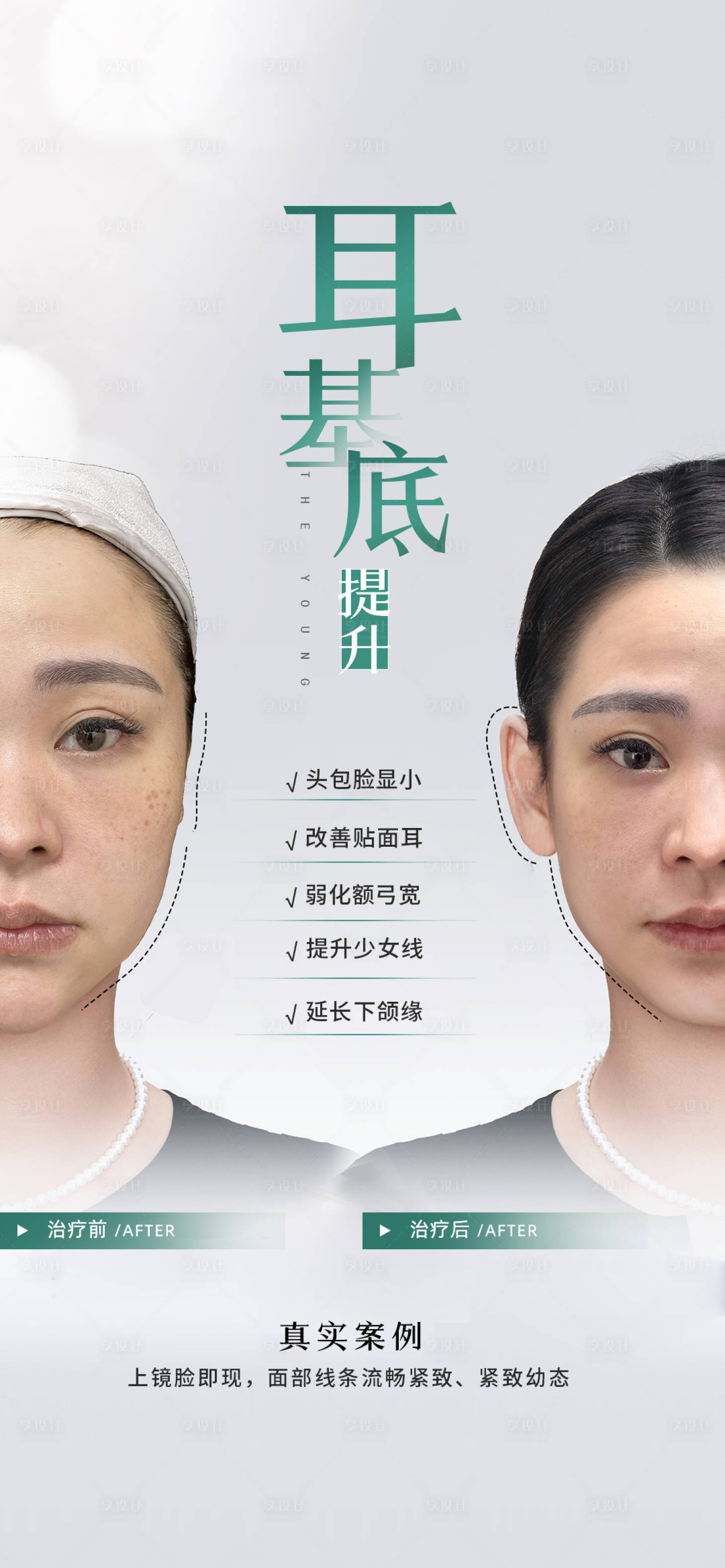 源文件下载【享设计】搜索编号：20590018351829726【医美耳基底提升海报】