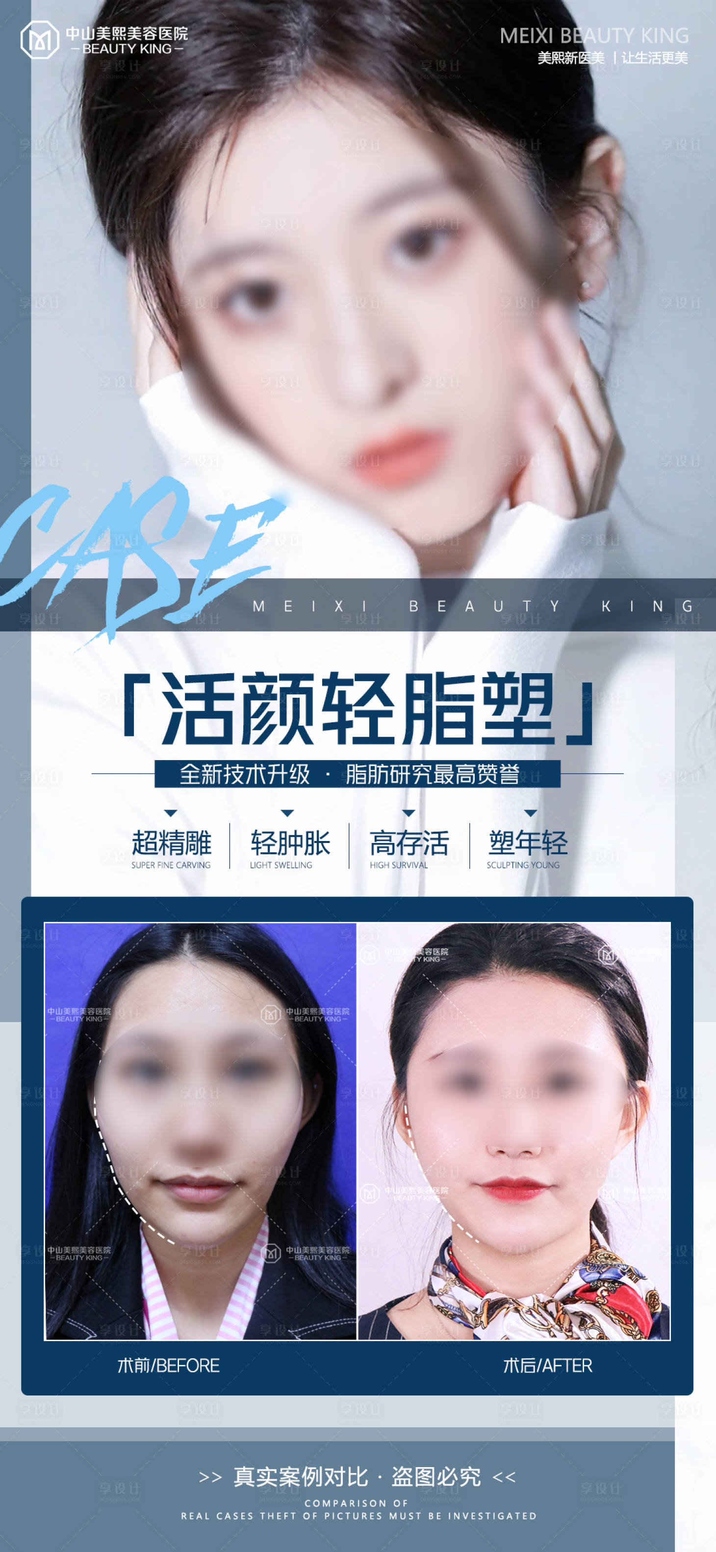源文件下載【享設(shè)計(jì)】搜索編號(hào)：74020017834828472【醫(yī)美臉部填充案例海報(bào)】
