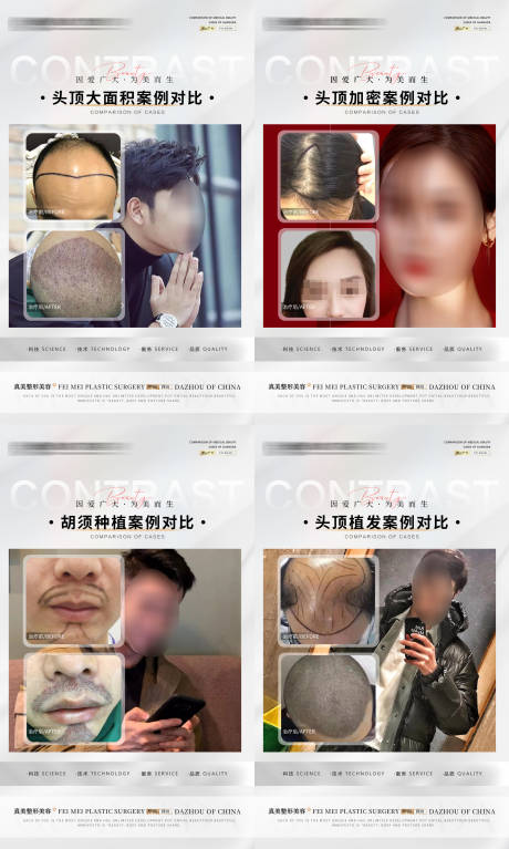 源文件下载【植发案例合集海报】编号：31870017844349892