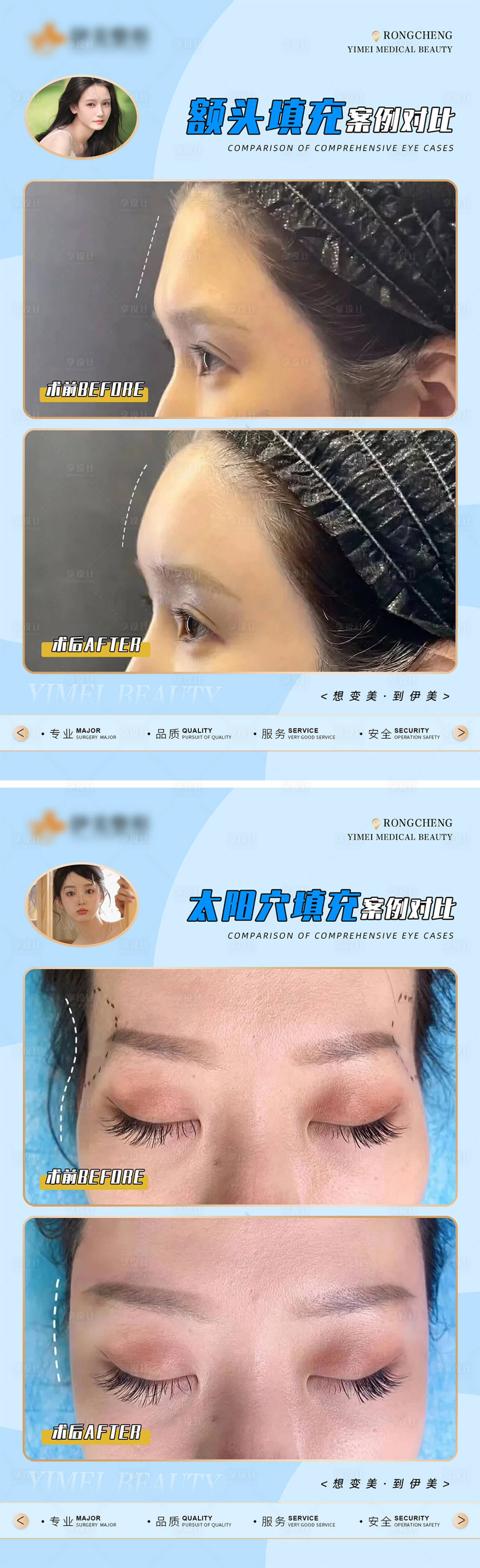 源文件下載【享設(shè)計】搜索編號：79350018336352720【醫(yī)美案例對比模版海報】