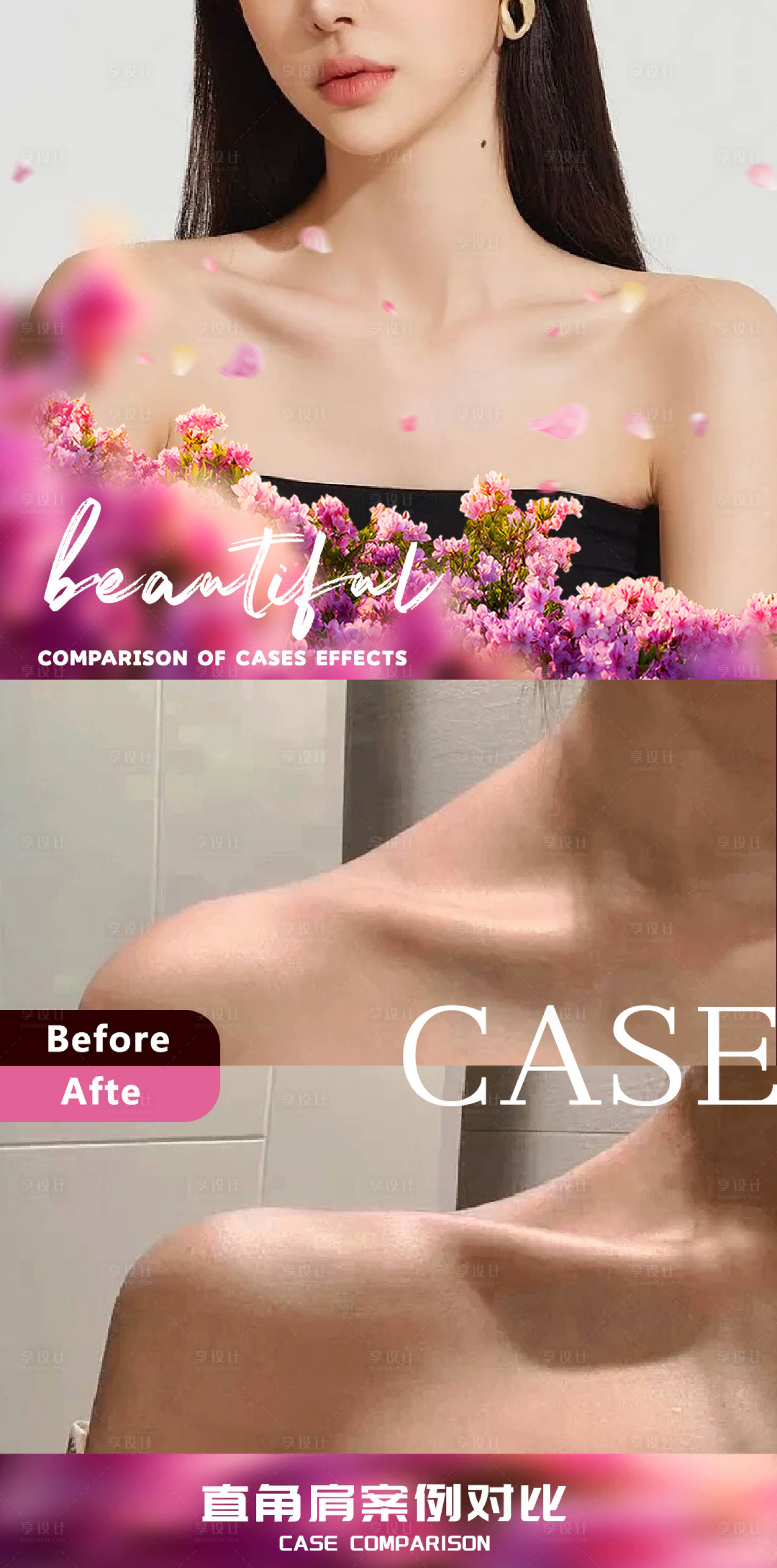 源文件下载【享设计】搜索编号：65540018394641602【玻尿酸直角肩案例对比】