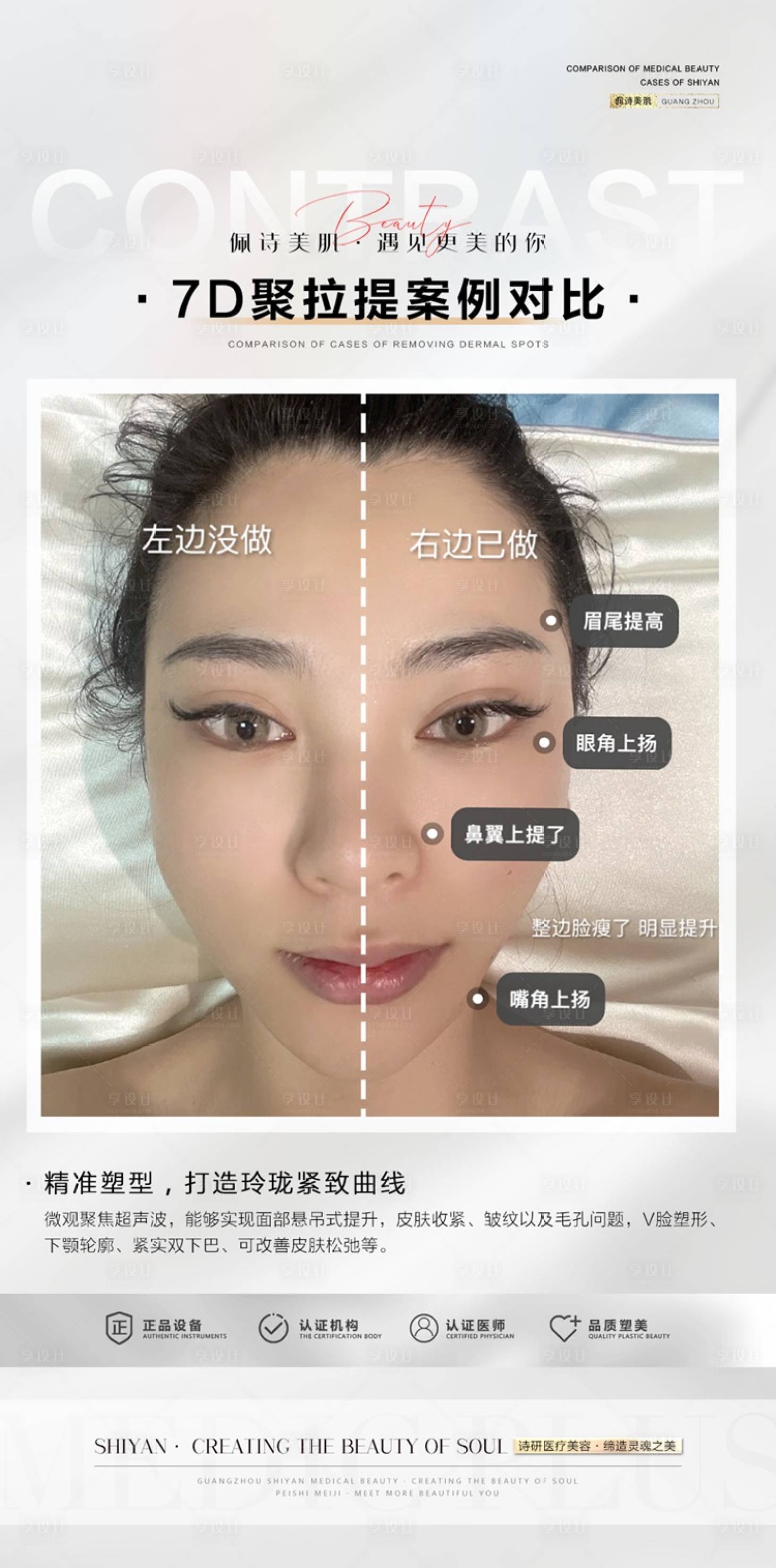 源文件下载【享设计】搜索编号：11780018102281923【7D聚拉提面部提升筋膜提升年轻化对比】