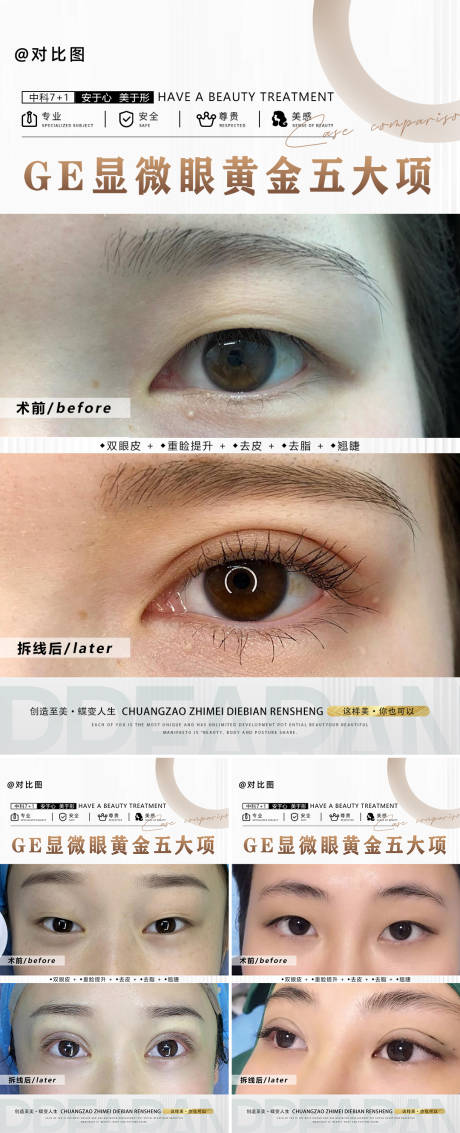 源文件下载【医美双眼皮对比案列】编号：90490018206226286