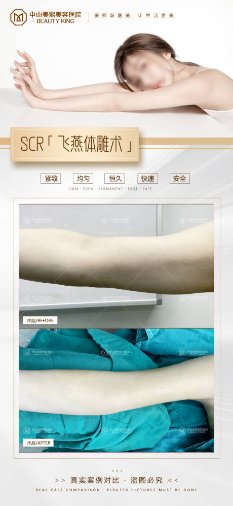 源文件下载【手臂吸脂案例】编号：35210017855571228
