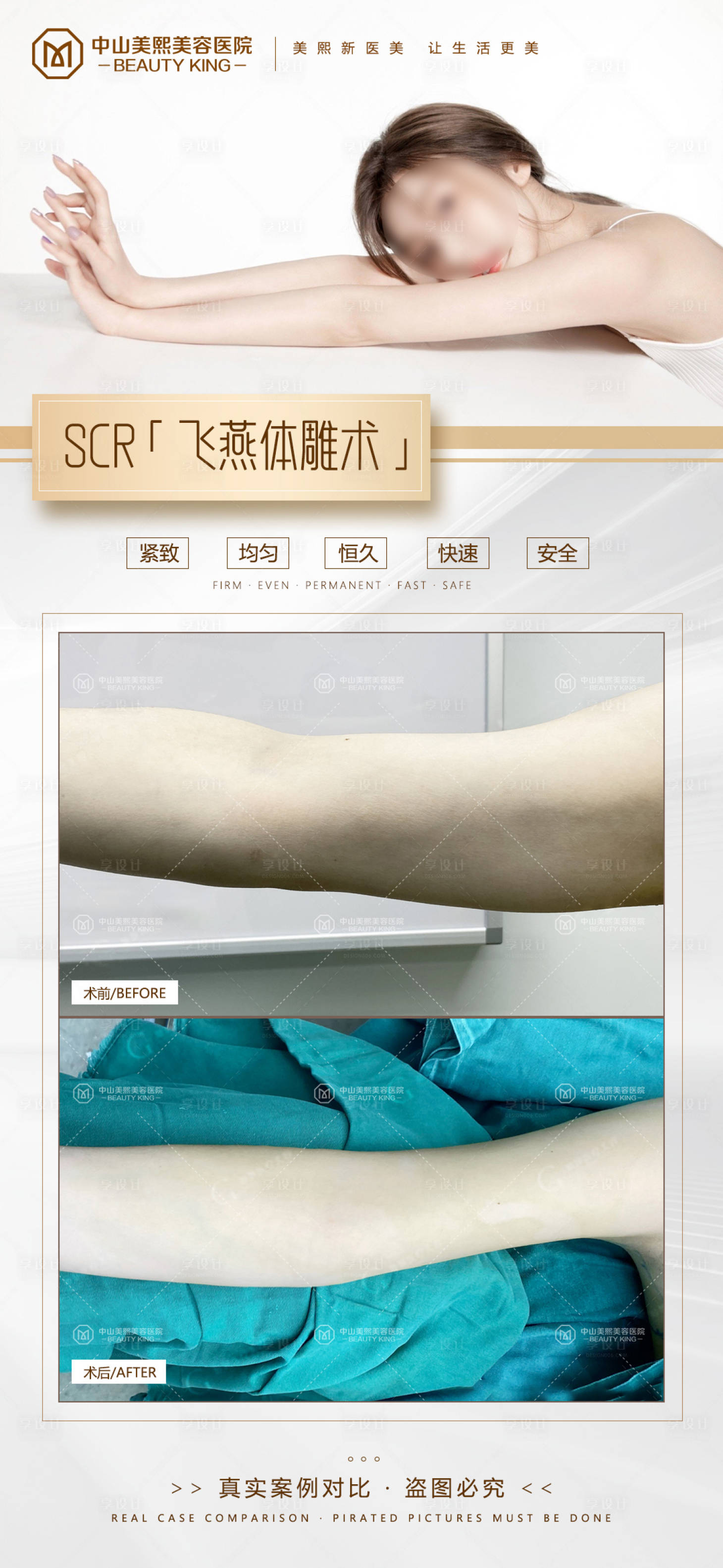 源文件下載【享設(shè)計(jì)】搜索編號(hào)：35210017855571228【手臂吸脂案例】