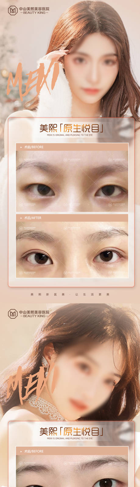 源文件下載【享設計】搜索編號：67170017834814955【雙眼皮案例海報】