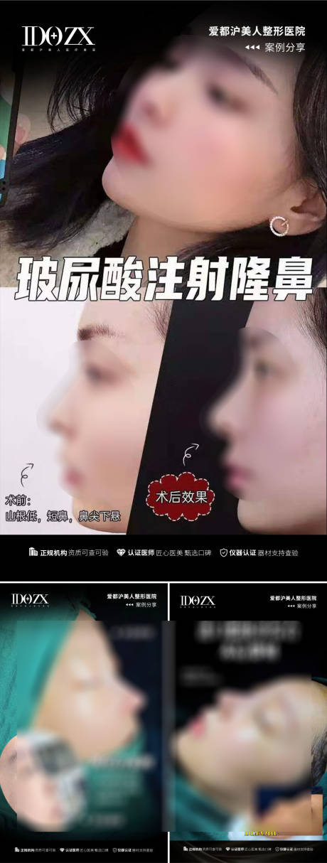 源文件下载【医美鼻综合案例海报】编号：20230824101215296