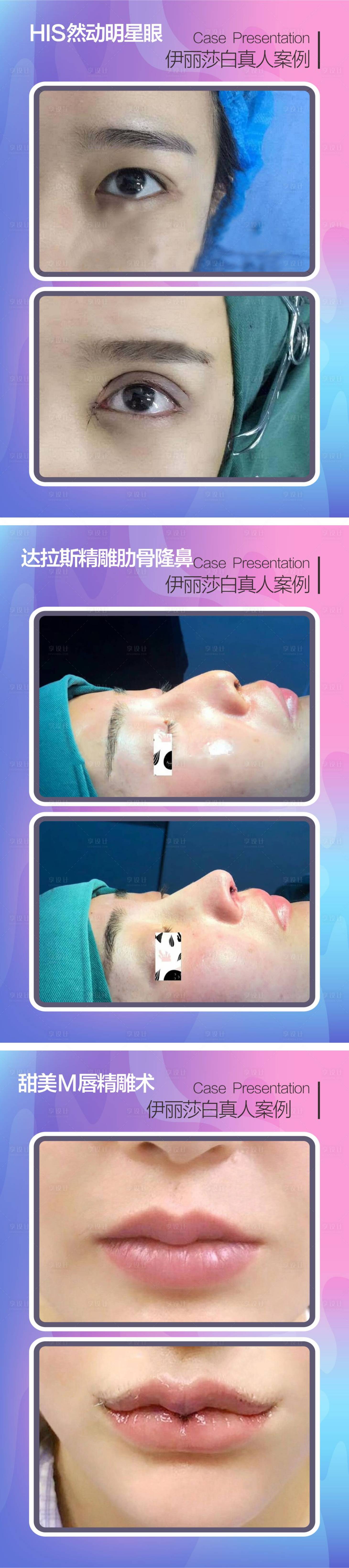 源文件下载【享设计】搜索编号：23740018925761905【医美眼鼻唇案例海报】