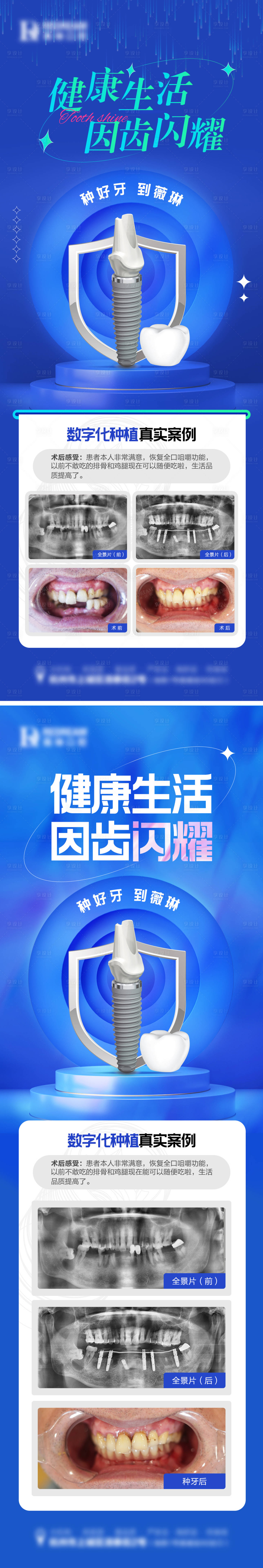 源文件下載【享設計】搜索編號：46830018773142211【口腔種植牙海報】