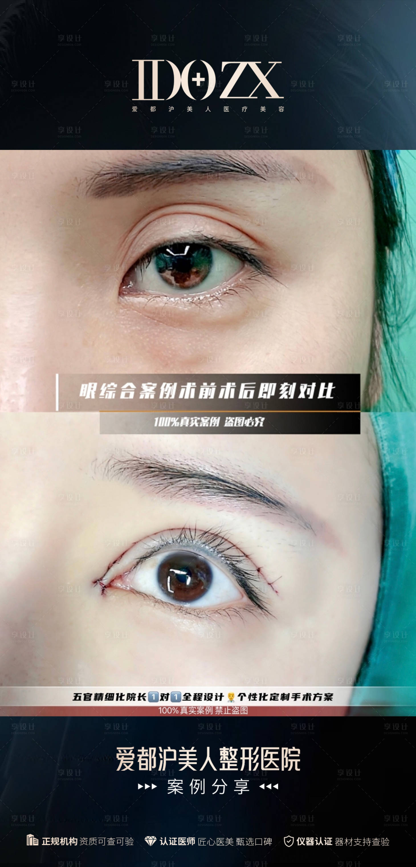 源文件下載【享設計】搜索編號：69190018690124106【醫美眼整形案例海報】