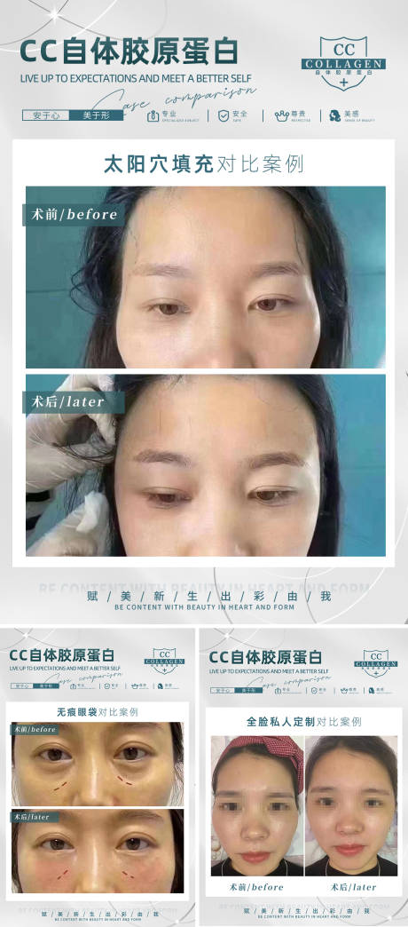 源文件下载【医美填充对比案例】编号：98380018474471934