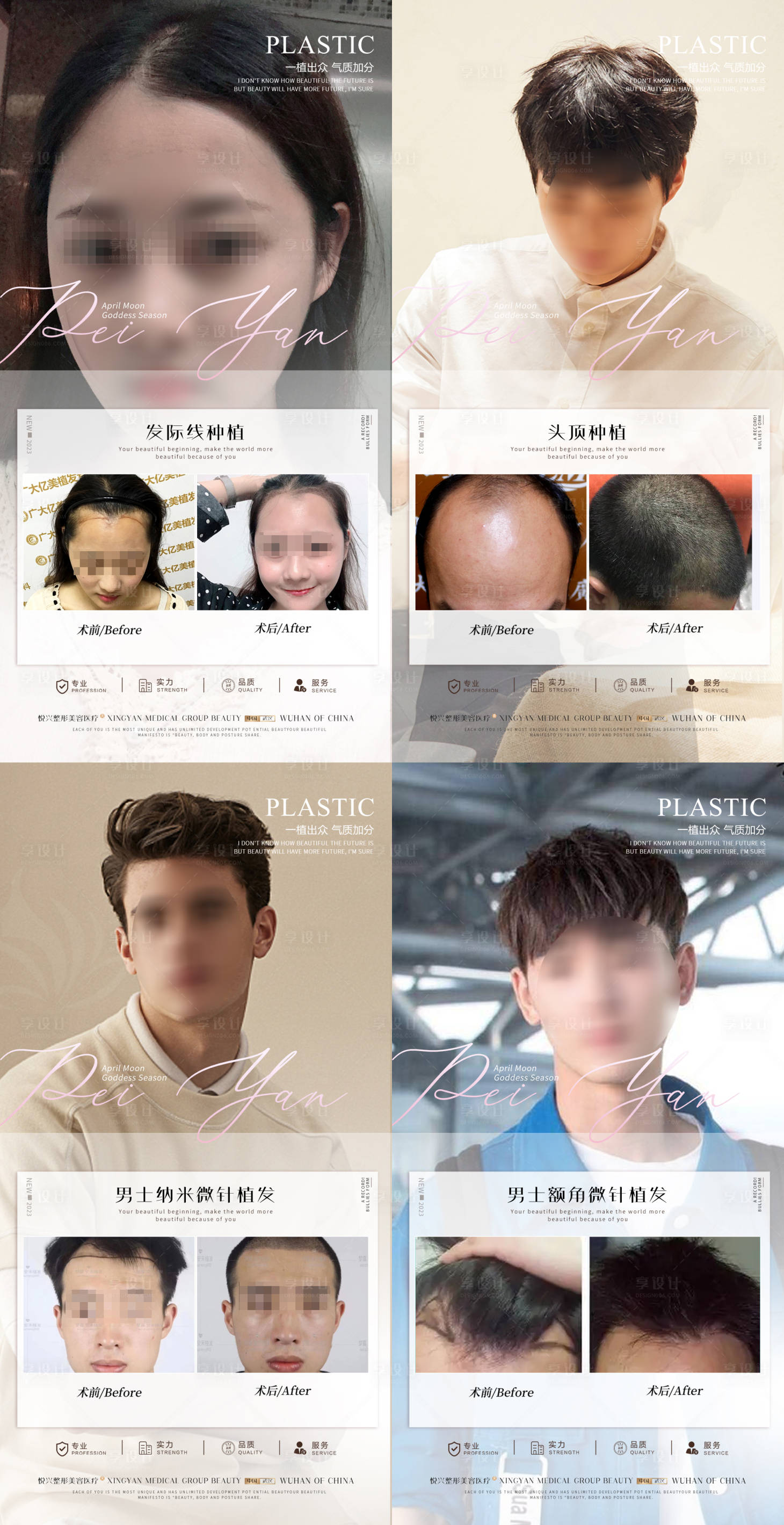 源文件下載【植發簡約案例對比】編號：97900019044179616
