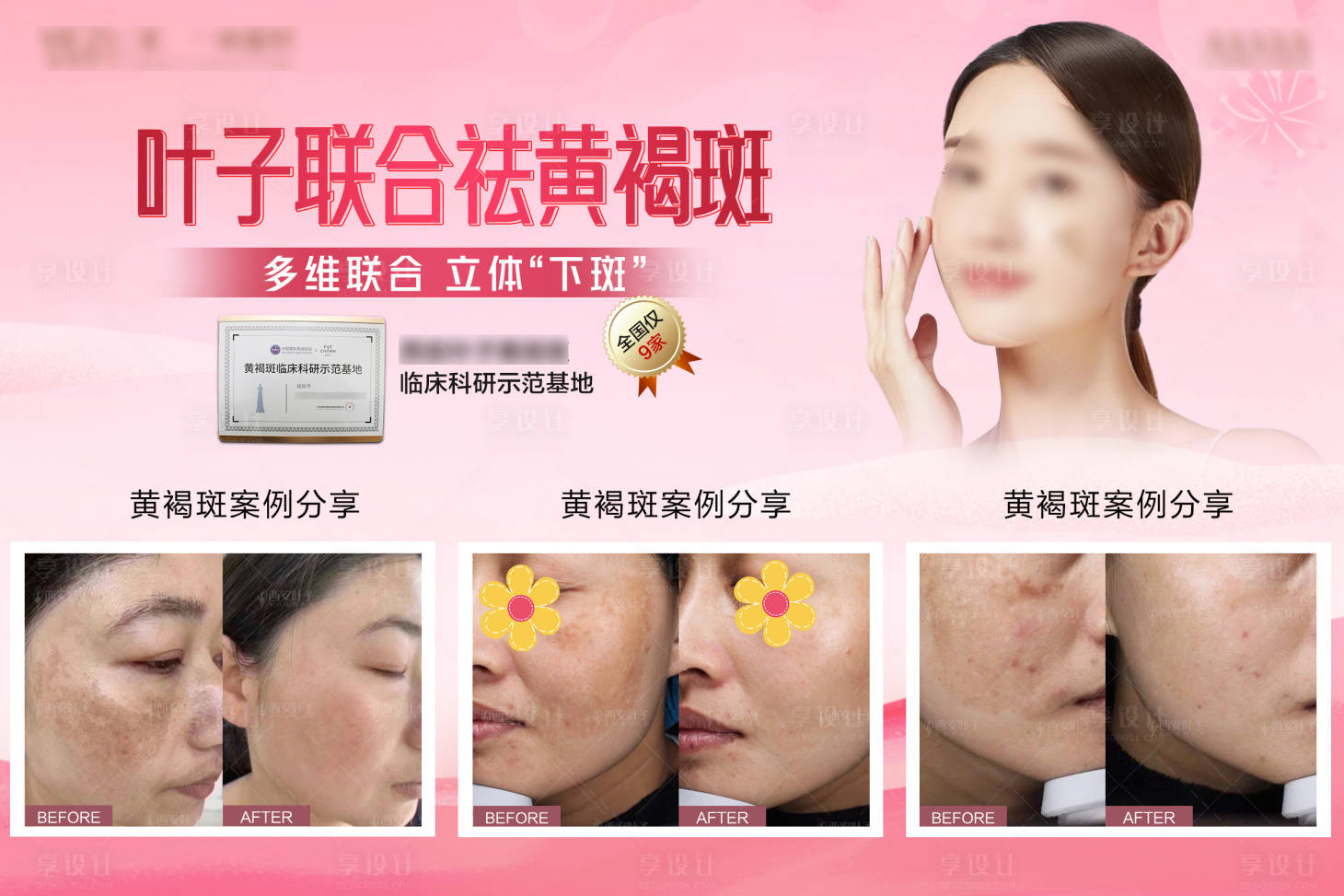 源文件下載【享設(shè)計】搜索編號：79260018914802151【醫(yī)美祛斑對比海報展板】