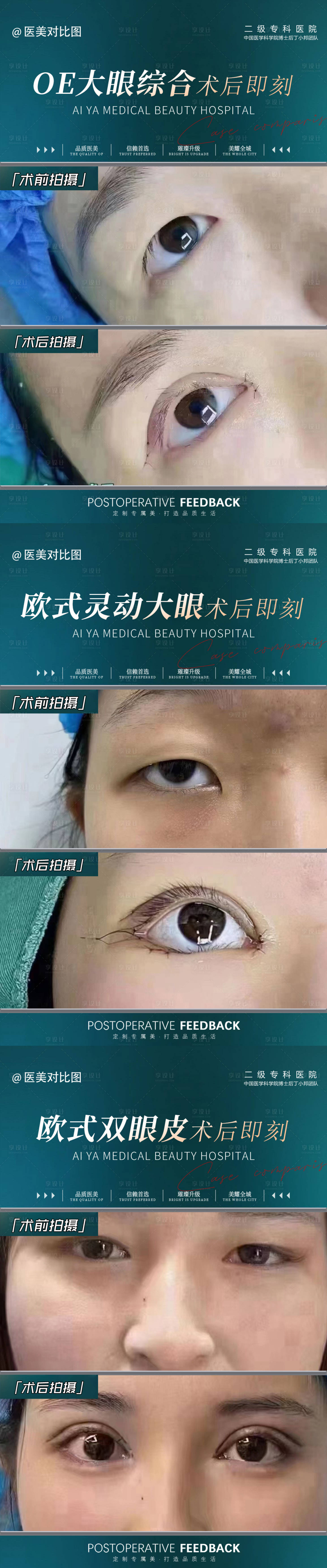 源文件下載【享設(shè)計】搜索編號：71420018945155094【醫(yī)美雙眼皮對比圖】