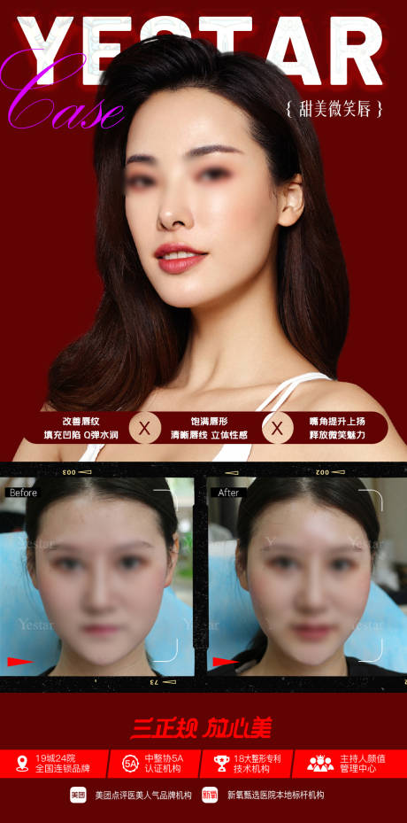 源文件下載【玻尿酸豐唇案例對比】編號：52860018540424971