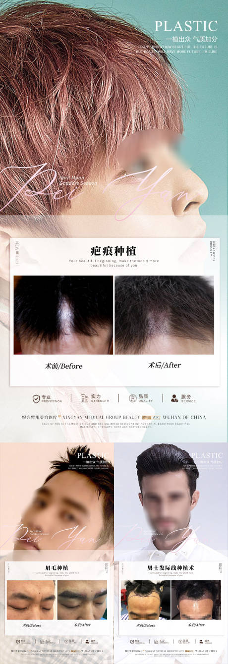 源文件下载【植发案例】编号：81690018441565290