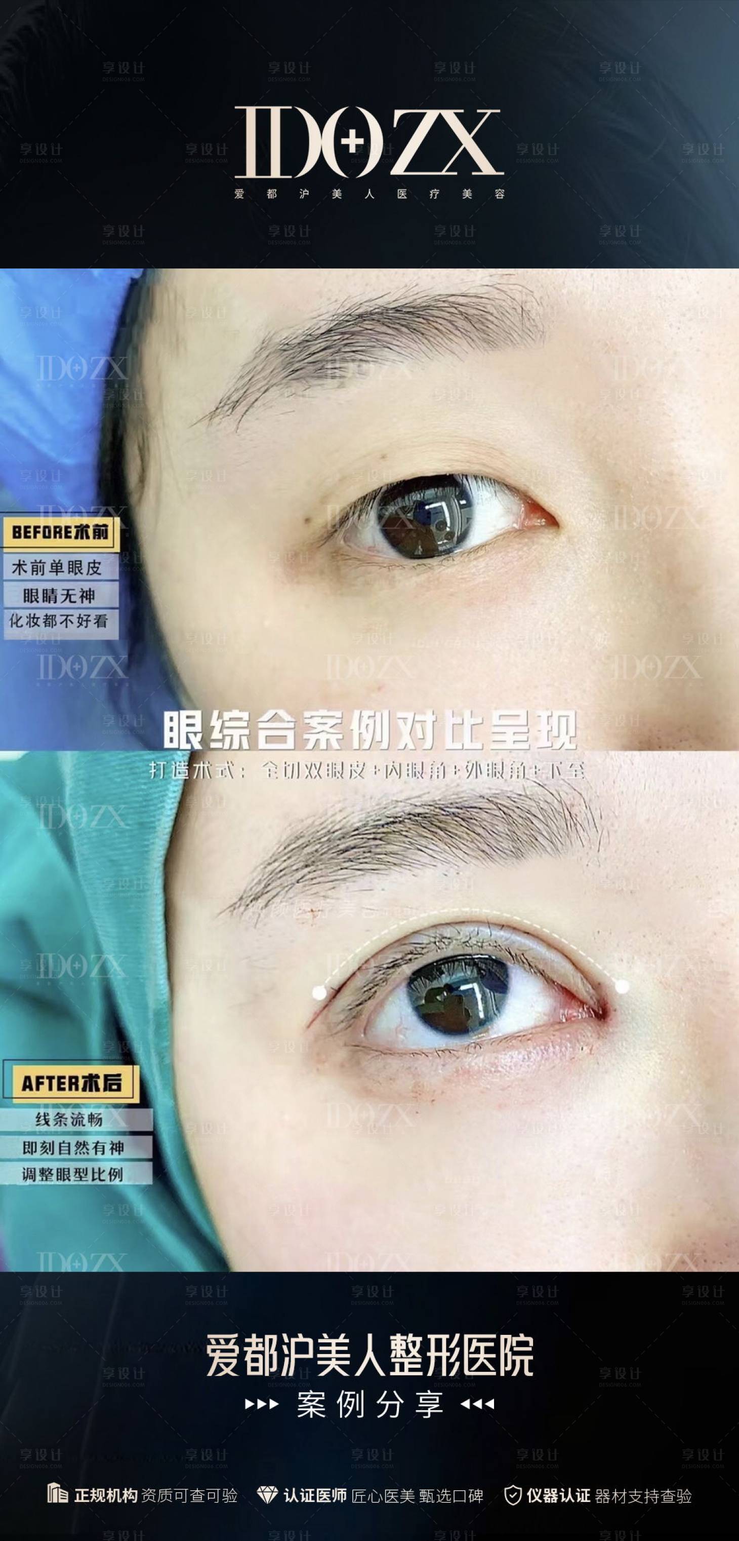 源文件下載【享設(shè)計】搜索編號：92560018680595141【醫(yī)美雙眼皮案例】