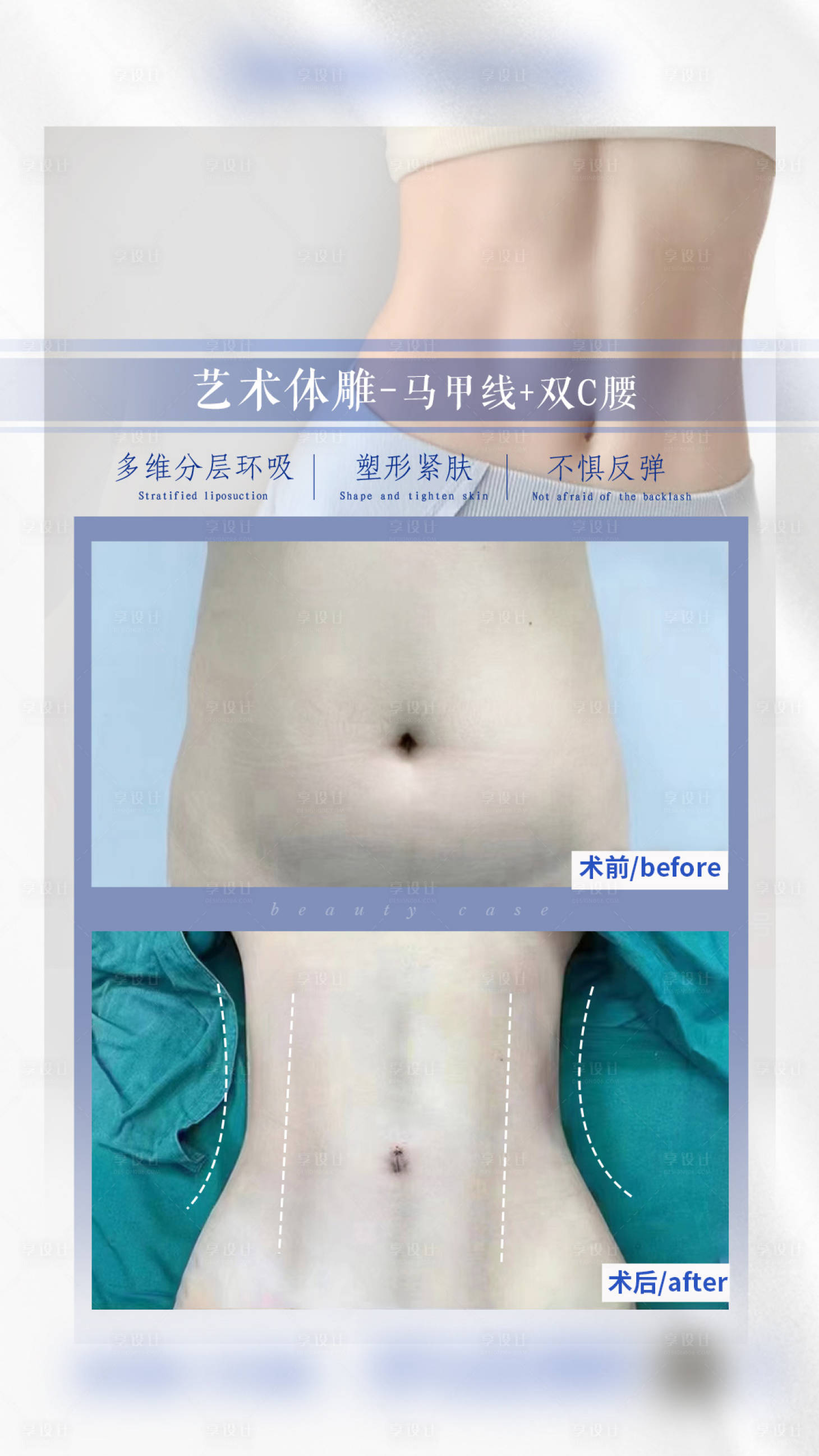 源文件下载【艺术体雕马甲线+双C腰案例】编号：55010018666935640