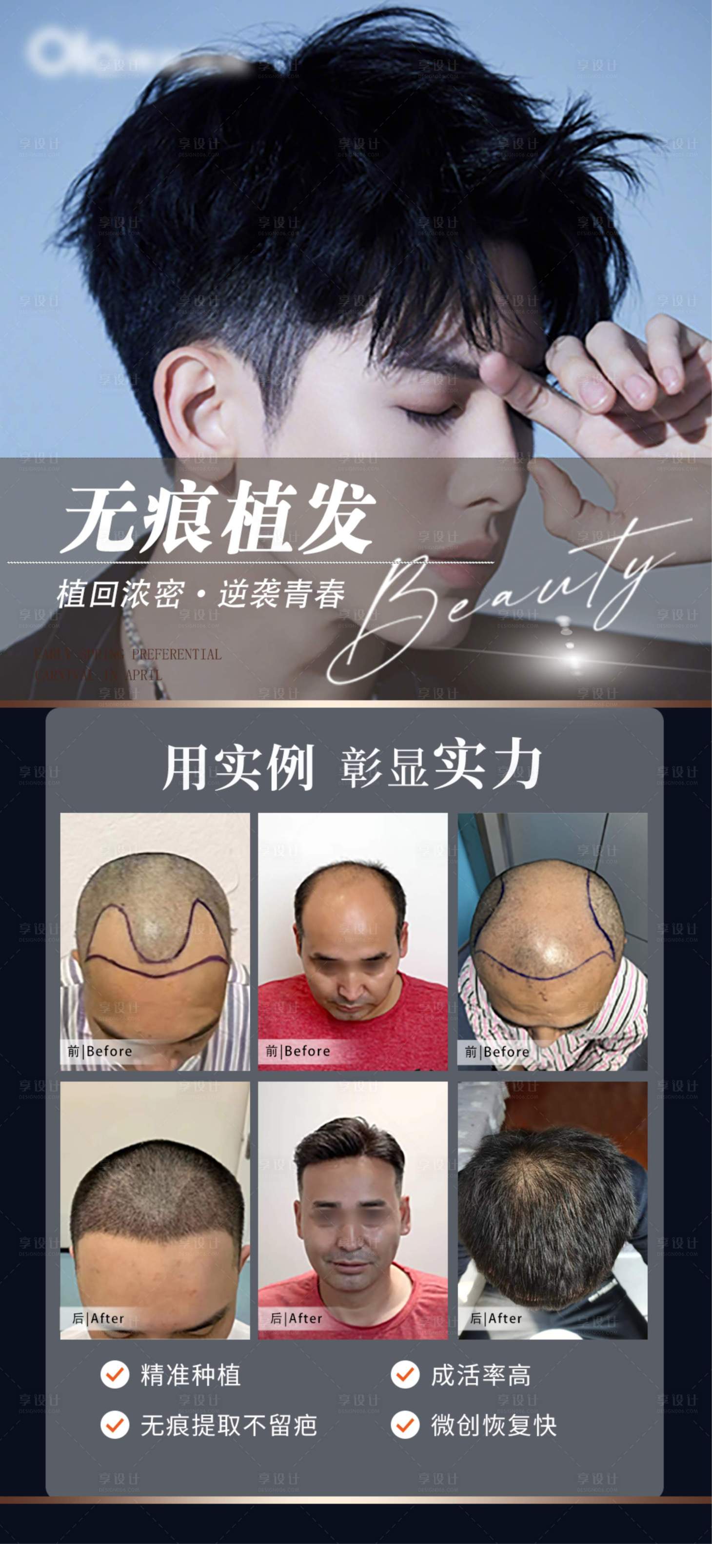 源文件下載【海報植發案例對比】編號：70520018682506698