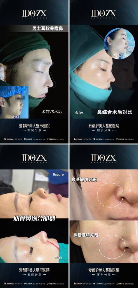源文件下载【享设计】搜索编号：95090018810261482【医美鼻整形案例海报】