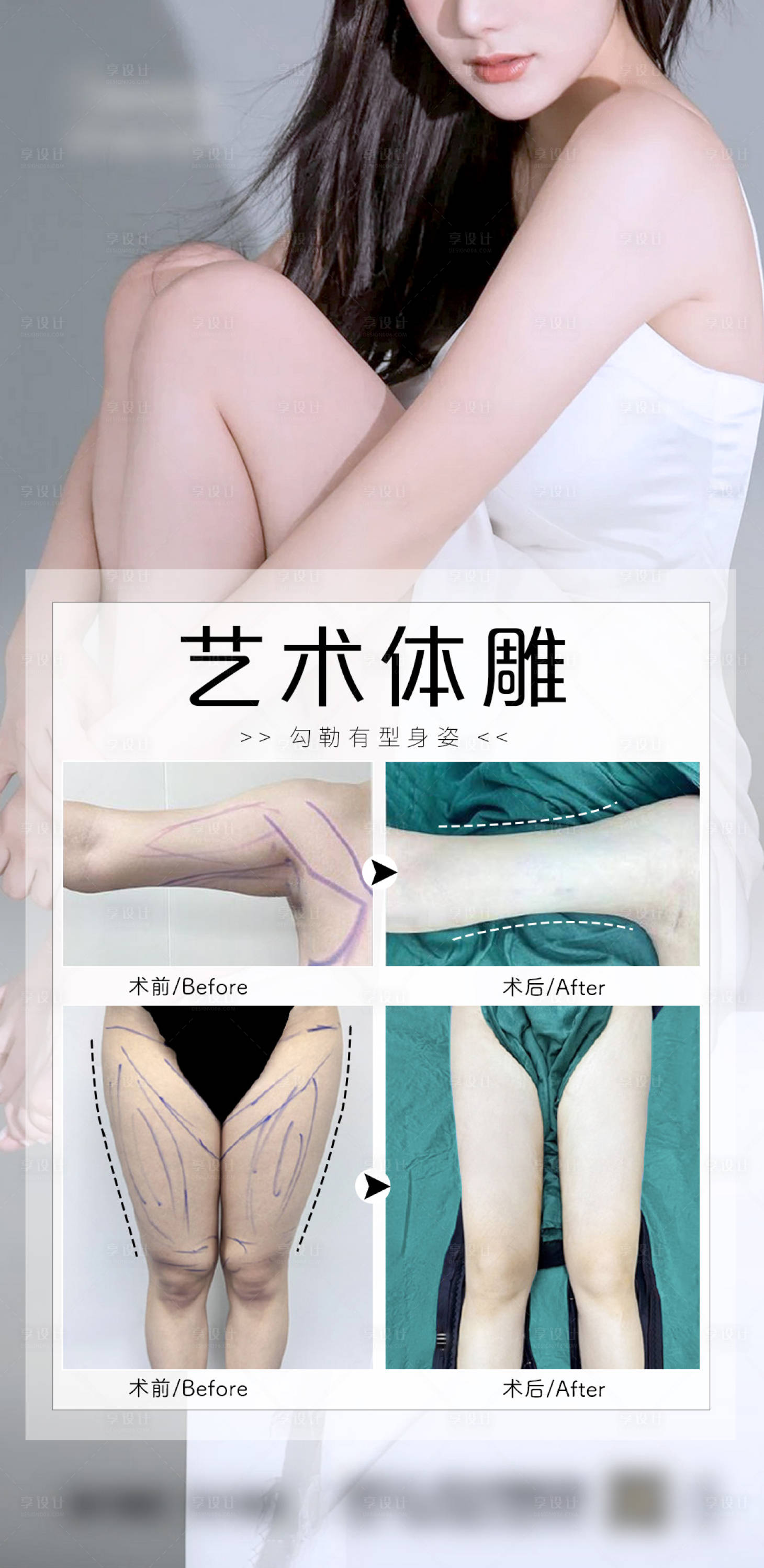 源文件下载【享设计】搜索编号：59200018975801146【医美吸脂案例宣传海报】