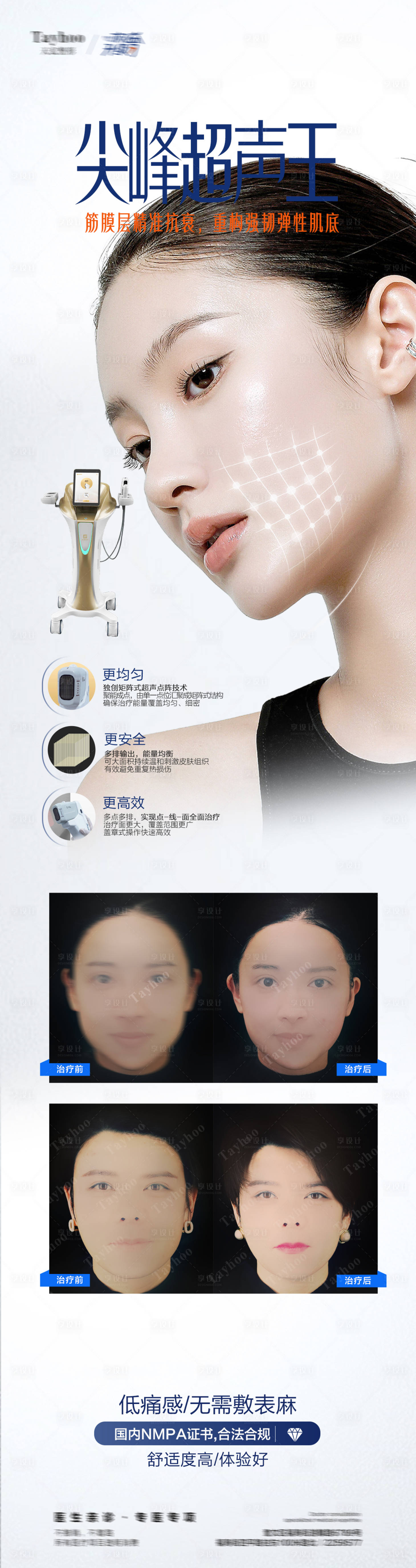 源文件下载【医美超声炮长图】编号：68530018959934043