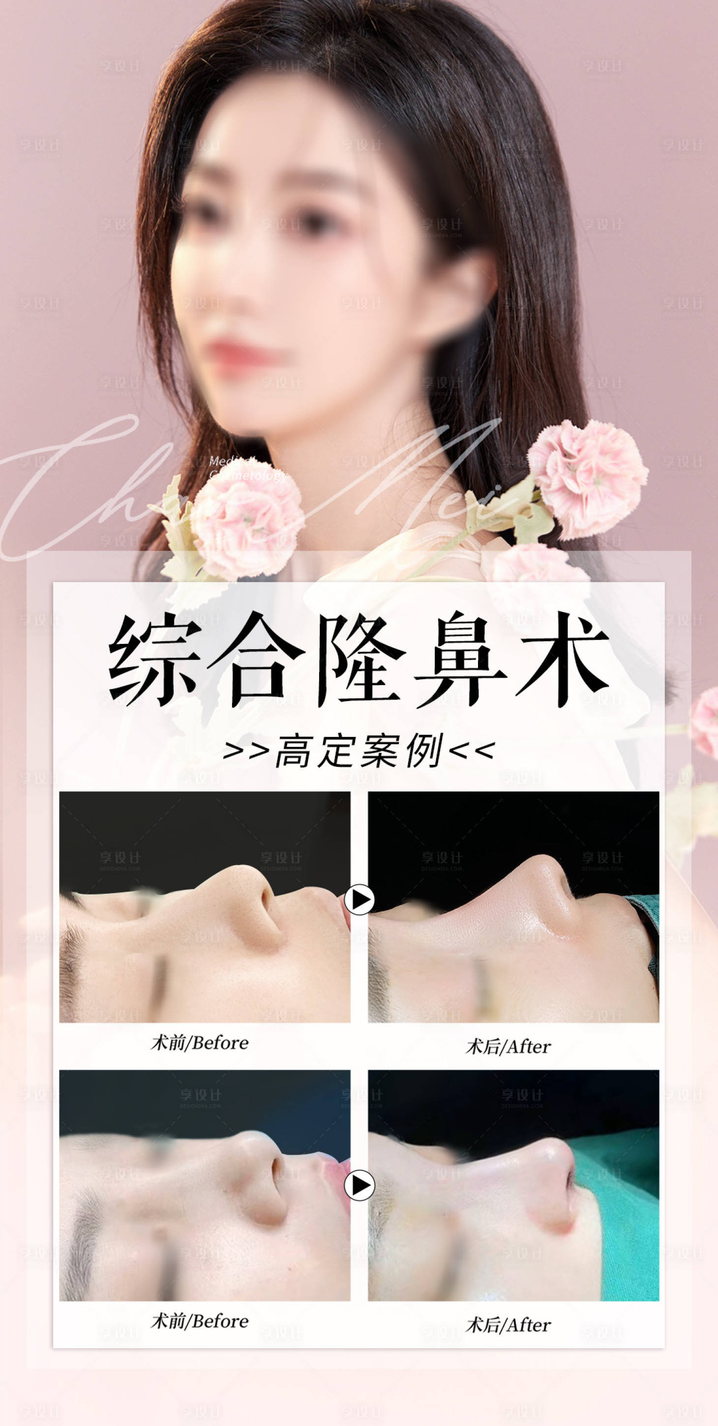 源文件下載【享設(shè)計】搜索編號：27450019399506467【隆鼻真人案例醫(yī)美整形項目】
