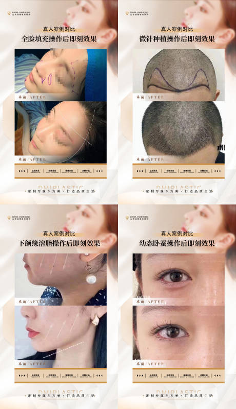 源文件下载【医美整形植发案例海报  】编号：75180019149237272