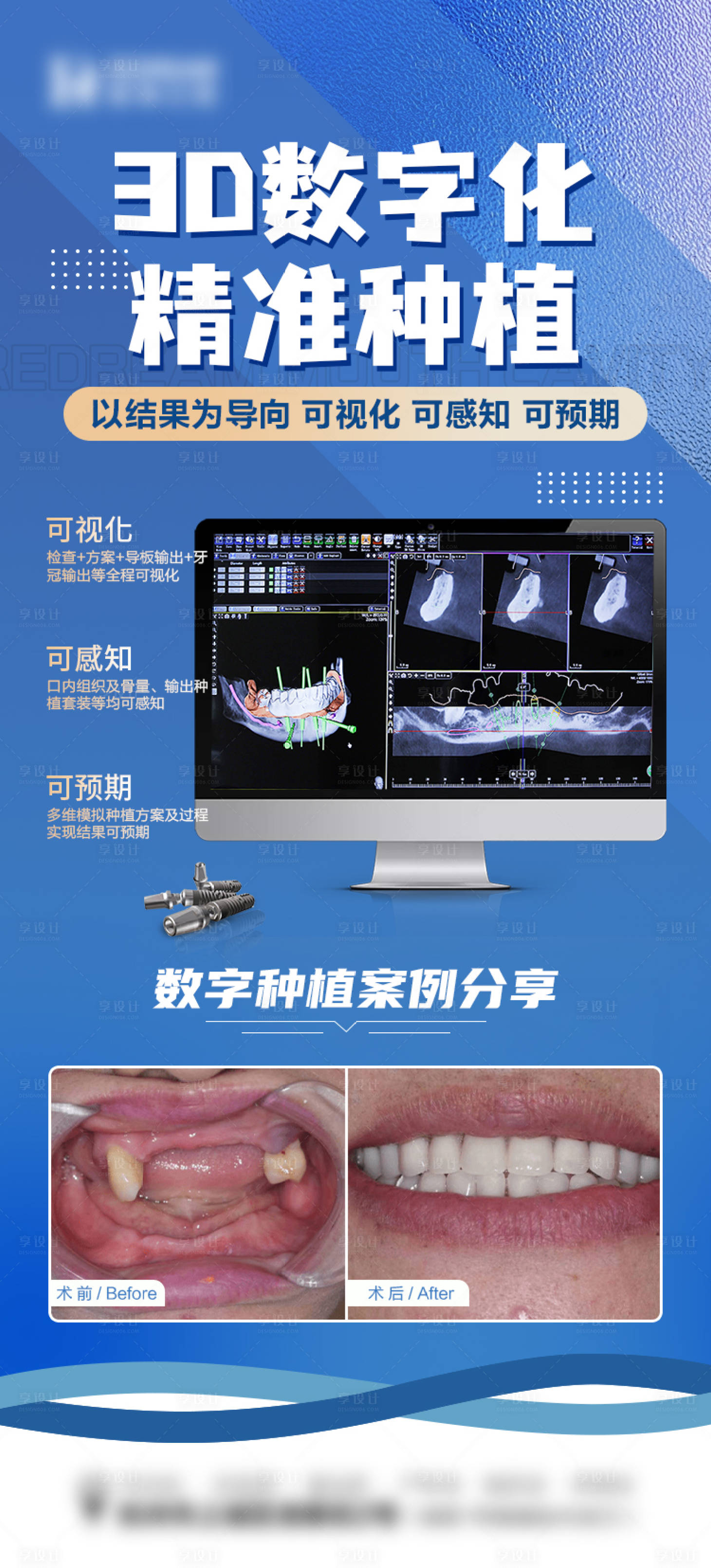 源文件下载【口腔种植牙】编号：97170019326205758