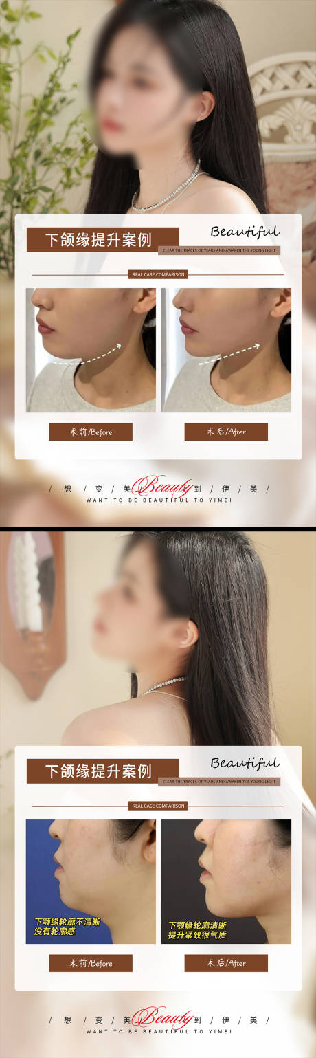 源文件下载【享设计】搜索编号：76660019112365580【下颌线提升案例】